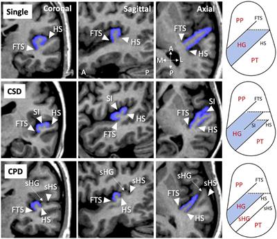 Different Heschl’s Gyrus Duplication Patterns in Deficit and Non-deficit Subtypes of Schizophrenia